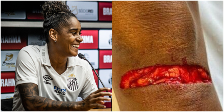 Giovana sofreu um corte profundo no joelho (Foto: Divulgação)